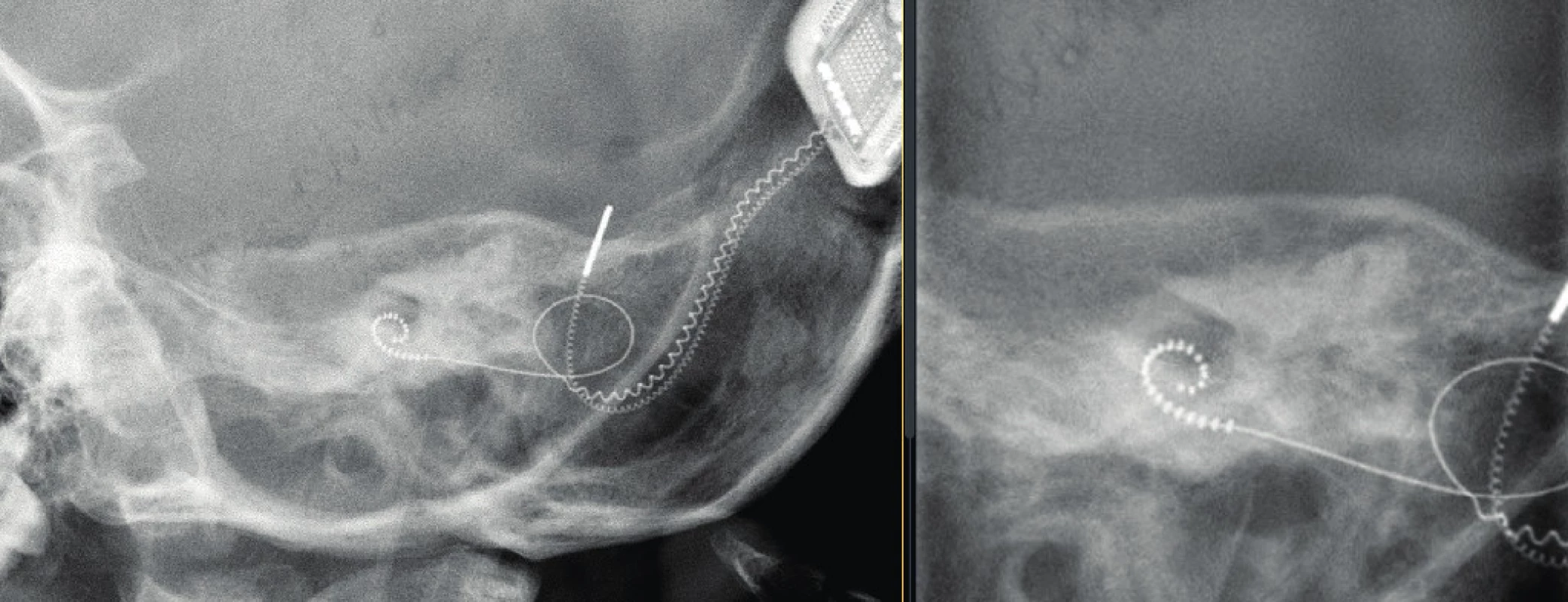 Nativní snímek hlavy – boční projekce, kochleární implantát levostranný. Vlevo pohled na celý implantát, vpravo detail
svazku elektrod v hlemýždi.