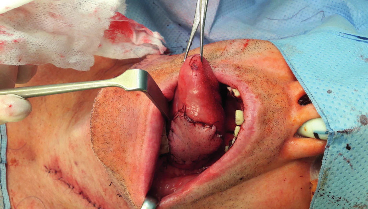 Condition afterinsertion of the submental flap into the defect of the tongue (author’s archive)