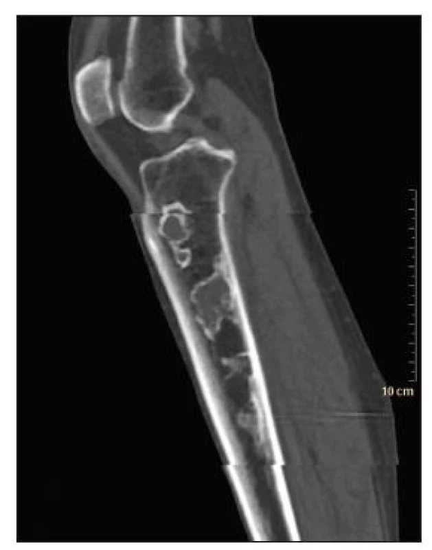 Low dose CT obraz pravého kolena, sagitální řez. Jsou patrná četná nepravidelná až serpiginozní cystická projasnění s jemným pravidelným sklerotickým lemem, bez patrné periostální reakce.