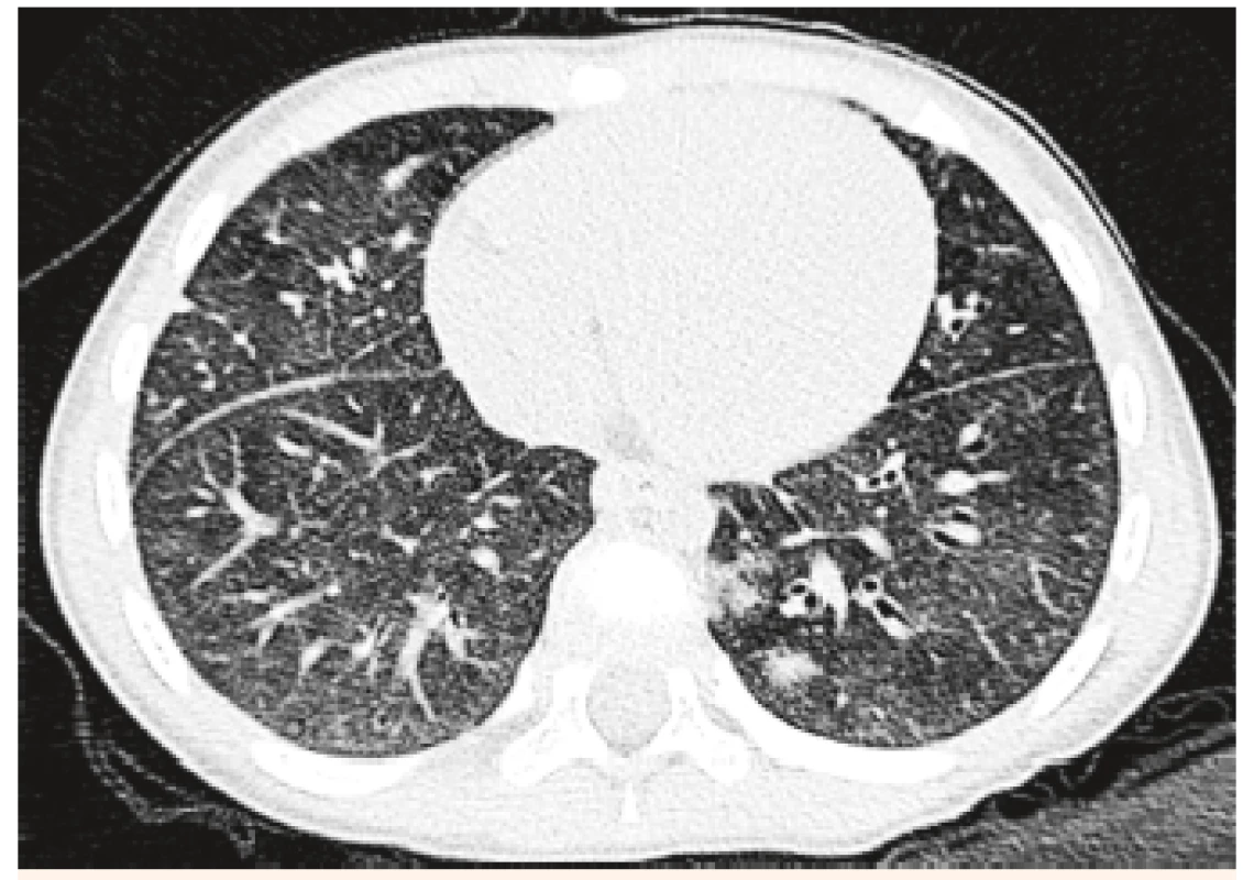 HRCT pľúc – vľavo parakadiálne hemoragické ložisko
u 4-ročnej pacientky.<br>
Fig. 4. HRCT examination of lung – left paracardial haemorrhagic
bearing in a 4-year patient.
