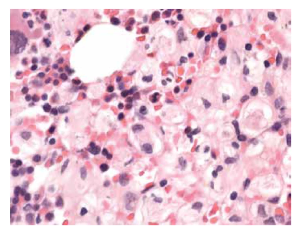 Základní barvení HE, intersticium dřeně vyplněno gaucherovými
buňkami s eosinofilním vláknitým materiálem. Buňky vzhledu „zmačkaného
papíru“ (zvětšení 400x).