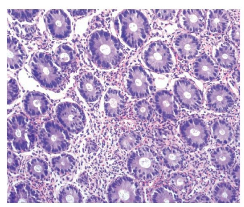Eosinofilní kolitida. V lamina propria kolické sliznice je zánětlivá celulizace
s převažující účastí velmi početných eosinofilů, které jeví tendenci ke
shlukování a místy prostupují do výstelky krypt (hematoxylin a eosin; 200x).
