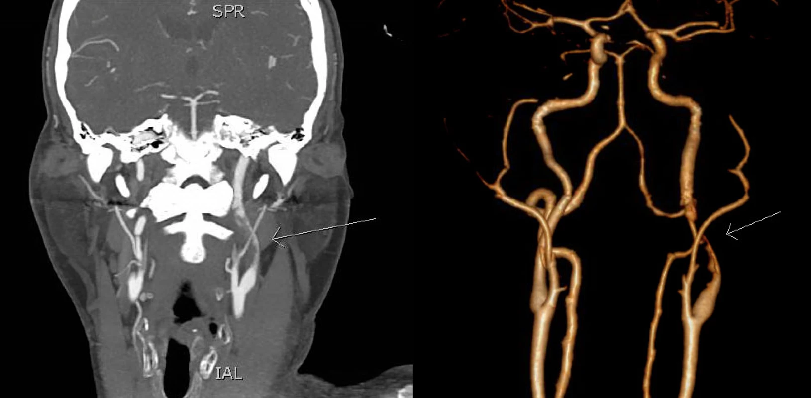 CTA in coronal section (left) and 3D reconstruction (right) shows short intraluminal filling defect in the M2 segment of the left MCA (arrow). MCA – middle cerebral artery<br>
Obr. 1 CTA ve frontálním řezu (vlevo) a 3D rekonstrukce (vpravo) ukazuje krátký intraluminální defekt v úseku M2 levé ACM (šipka). ACM – arteria cerbri media