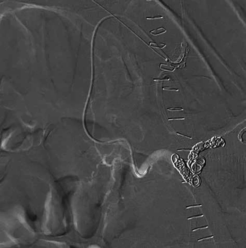 Stav po transarteriální embolizaci aneuryzmatu 
PDA se zavedenými coily – snímky digitální subtrakční 
angiografie<br>
Fig. 3: Condition after transarterial embolisation of the 
PDA aneurysma with deployed coils – images of digital 
subtraction angiography