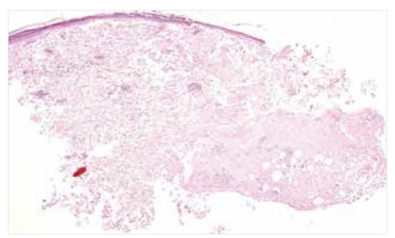 Nodulární amyloidóza – histopatologie<br>
Amorfní eozinofilní depozita amyloidu v dermis a podkoží.
Barvení HE, původní zvětšení 20krát.