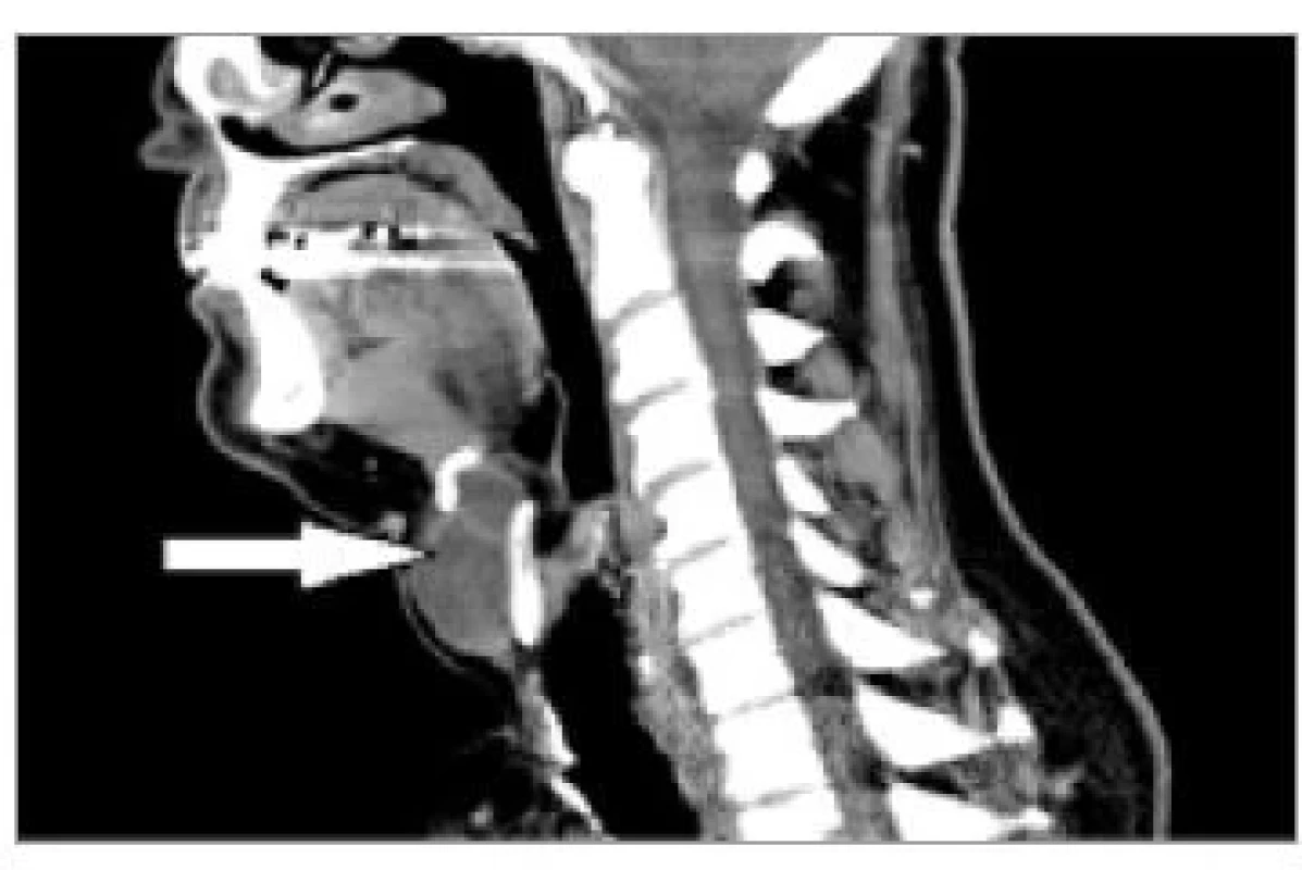 a. CT krku boční projekce s kontrastem.
Šipka označuje cystický, septovaný
útvar na křídle chrupavky
štítné, přechází nad horní hranu
štítné chrupavky do preepiglotického
lože.<br>
Fig. 1a. Neck CT lateral projection with
contrast medium. The arrow indicates
a cystic, septate formation on the thyroid
cartilage lamina, passing over the
superior thyroid notch into the preepiglotic
space.