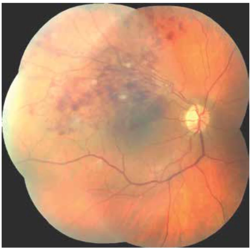 Sítnice pravého oka u pacienta s okluzí horní temporální větve centrální sítnicové
žíly – snímek pořízený při indikaci intravitreální léčby ranibizumabem, na sítnici nález stříkancovitých
hemoragií a vatovitých ložisek v oblasti centra a v horním temporálním kvadrantu
sítnice, nejlepší korigovaná zraková ostrost vpravo v době indikace 6/30