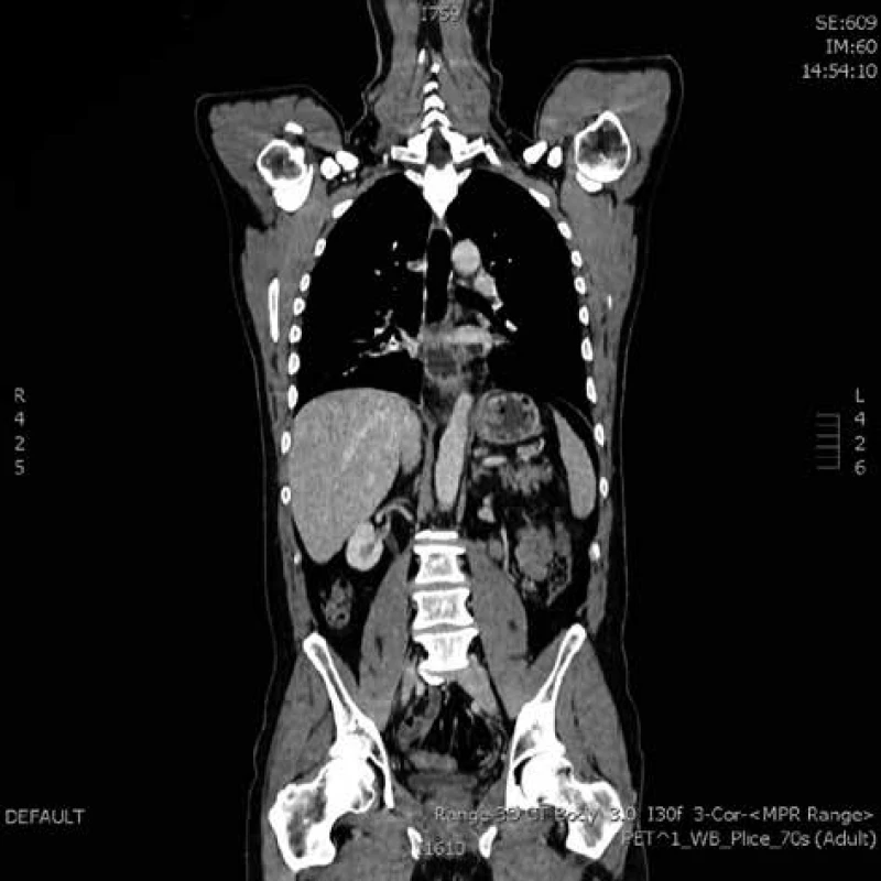 Kontrolní PET/CT v rámci restagingu po neoadjuvantní
radiochemoterapii (koronární řez)<br>
Fig. 2: PET-CT in restaging after neoadjuvant chemoradiotherapy
(coronal reconstruction)