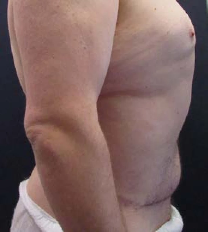 Lower body lifting – pooperační foto z boku
