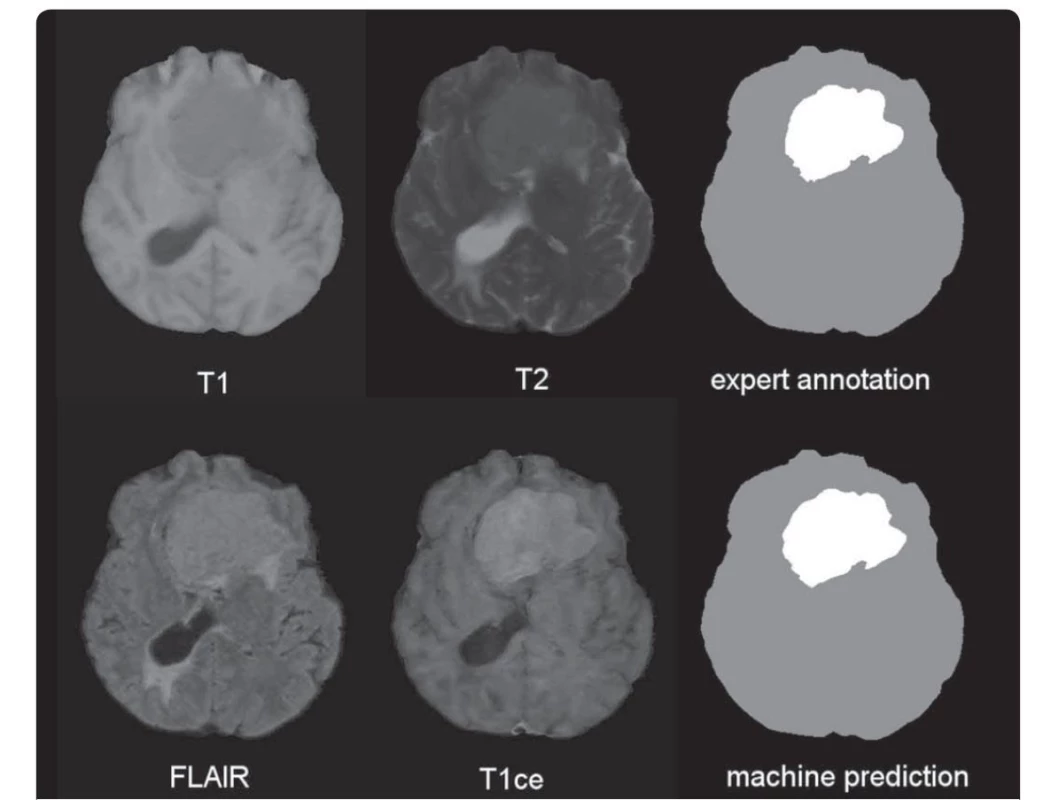 Ukázka vstupních dat nádoru mozku pořízených ve čtyřech modalitách MR: T1, T2, FLAIR a T1ce (T1 s kontrastní látkou).
V pravém sloupci je srovnání ruční anotace správného výsledku segmentace postižené části mozku a výsledku automatizované počítačové
analýzy.