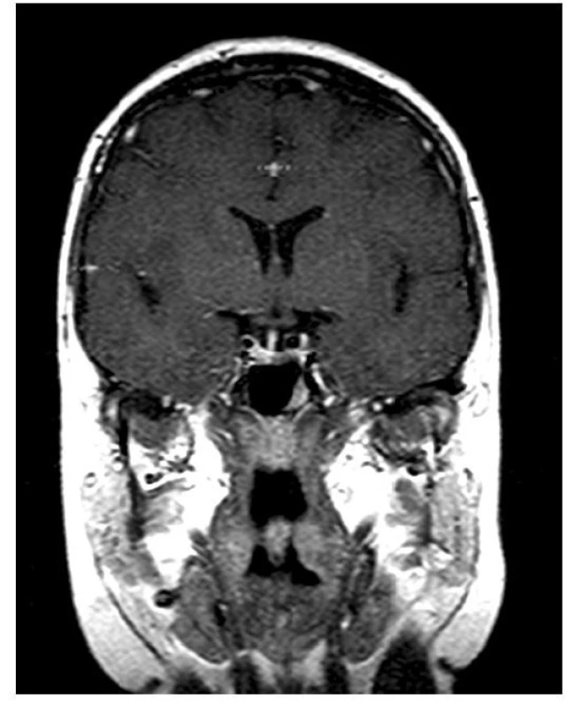 MR obraz mikroadenomu hypofýzy (archiv autora
a Radiodiagnostické kliniky Všeobecné fakultní nemocnice a 1. LF UK v Praze)