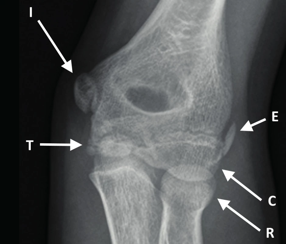 a-b: Overview of ossification nidi of the elbow joint, boy, 13 years of age. C – capitulum humeri, R – caput radii, I – epicondylus medialis, T – trochlea humeri, O – olecranon, E – epicondylus lateralis
