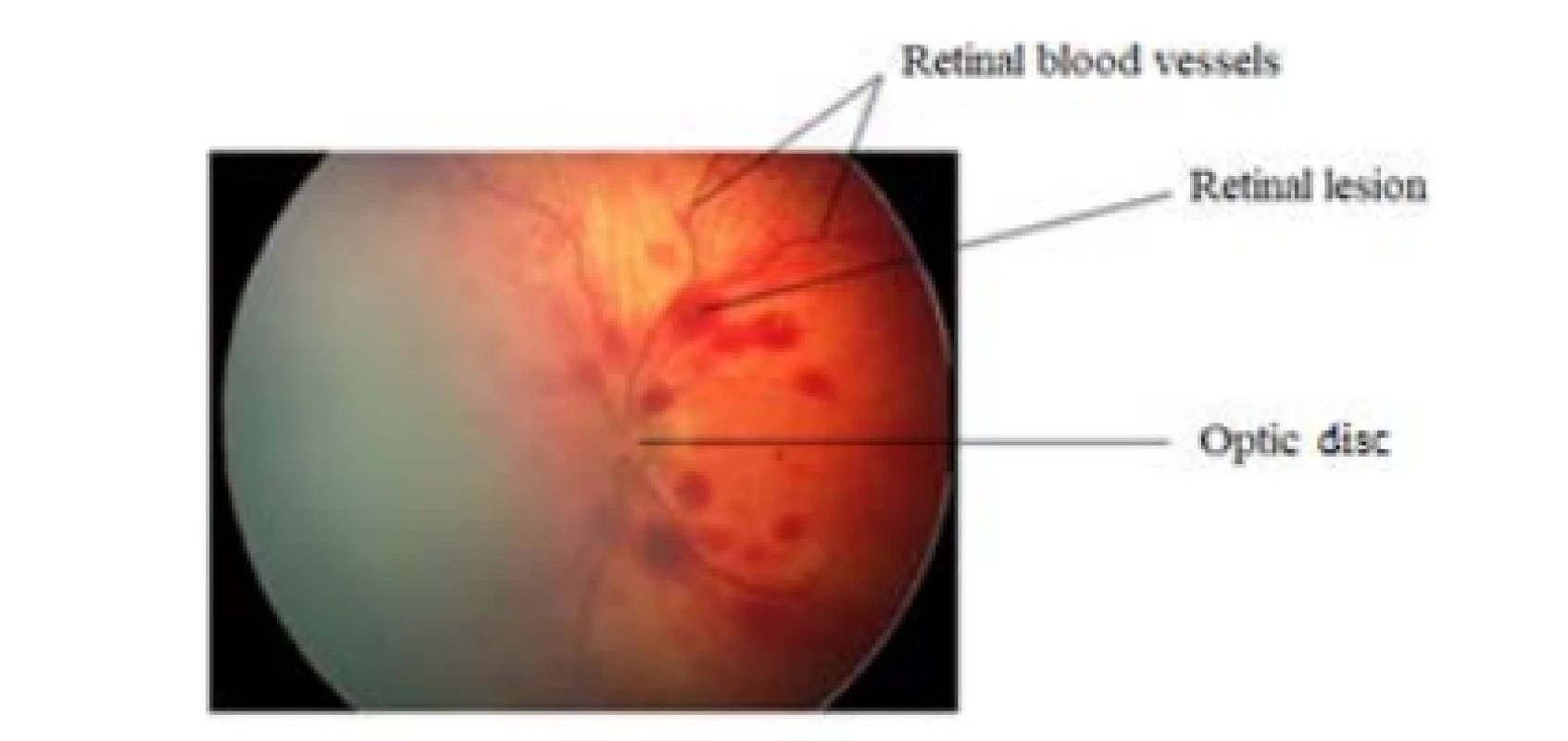 Description of a retinal image from RetCam3.