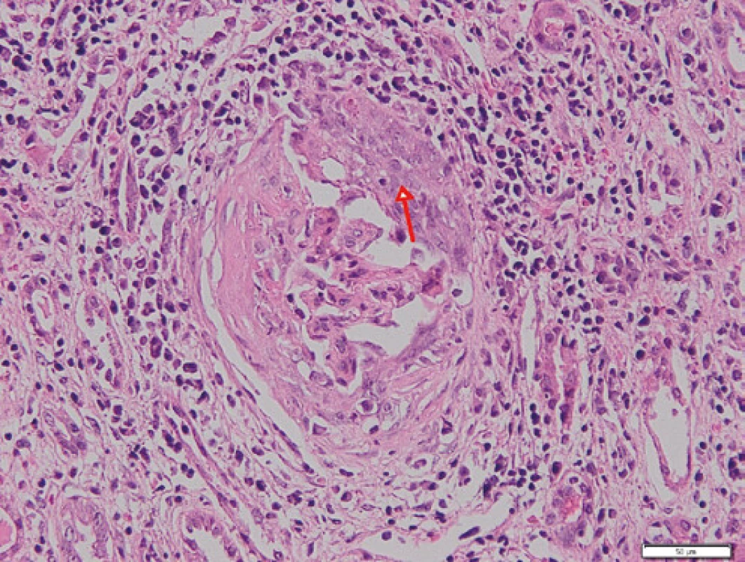 Glomerulus s celulárním srpkem (červená šipka), v okolí glomerulu 
je v intersticiu intenzivní zánětlivý infiltrát; barvení HE