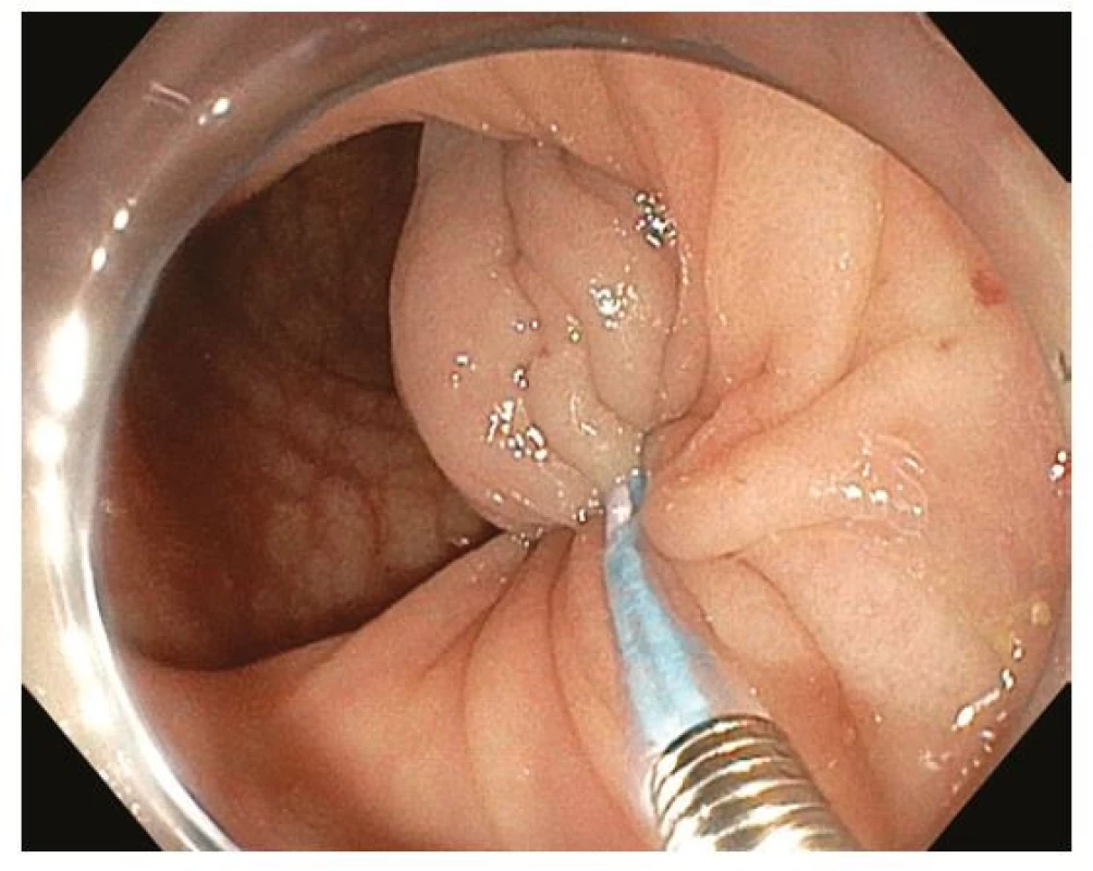 Endoskopická polypektomie – nasazení odnímatelné smyčky
(endoloop) na bázi stopky polypu