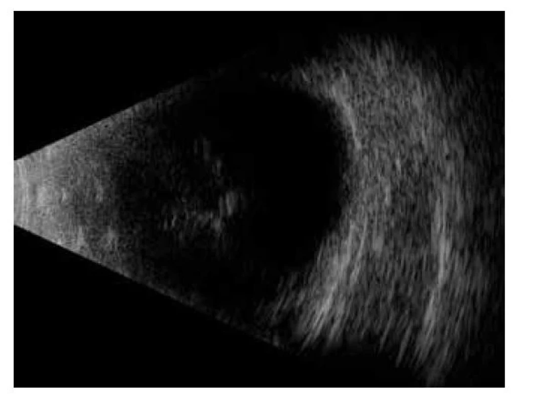 Zobrazení sklivcových zákalů pomocí ultrazvuku –
B scanu