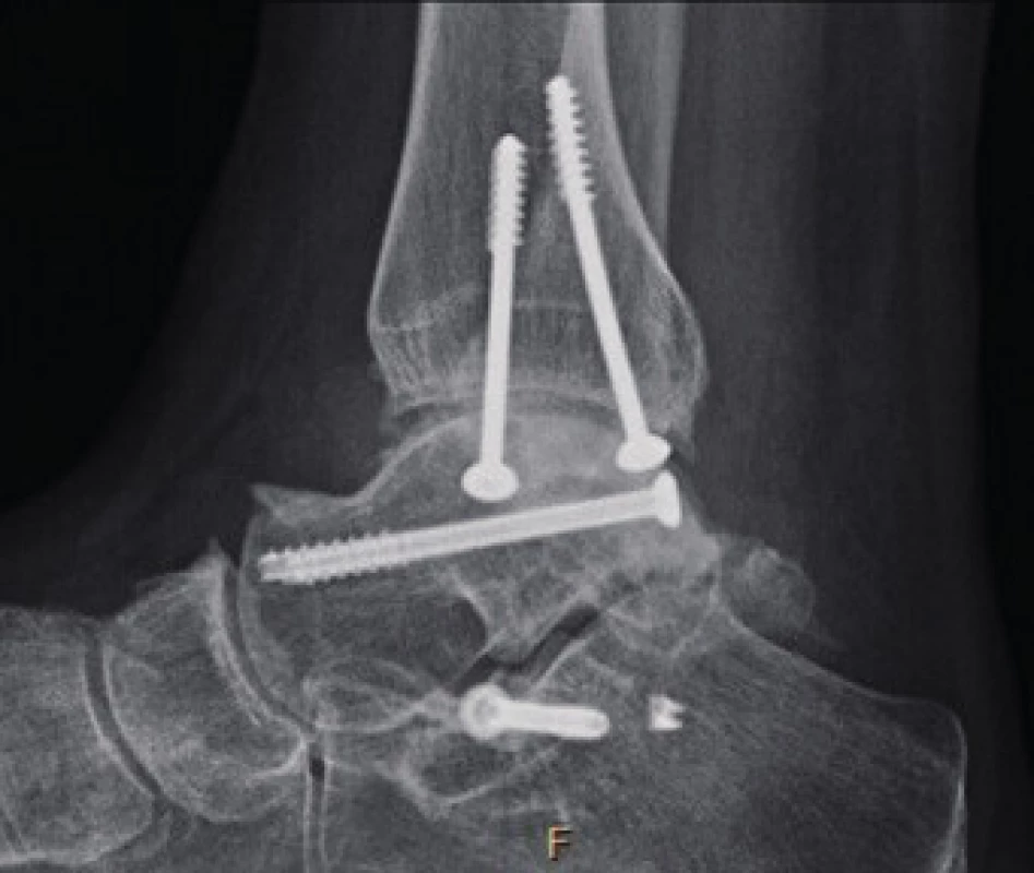 Ankle arthritis according to X-ray examination (AP and lateral
projection of the ankle