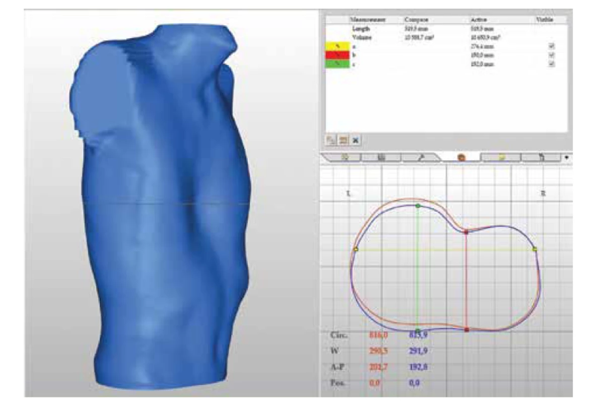 Ukážka výsledku 3D skenovania hrudníka (archív KDCH UNM).<br>
Fig. 3. Example of the result of a 3D chest scan.