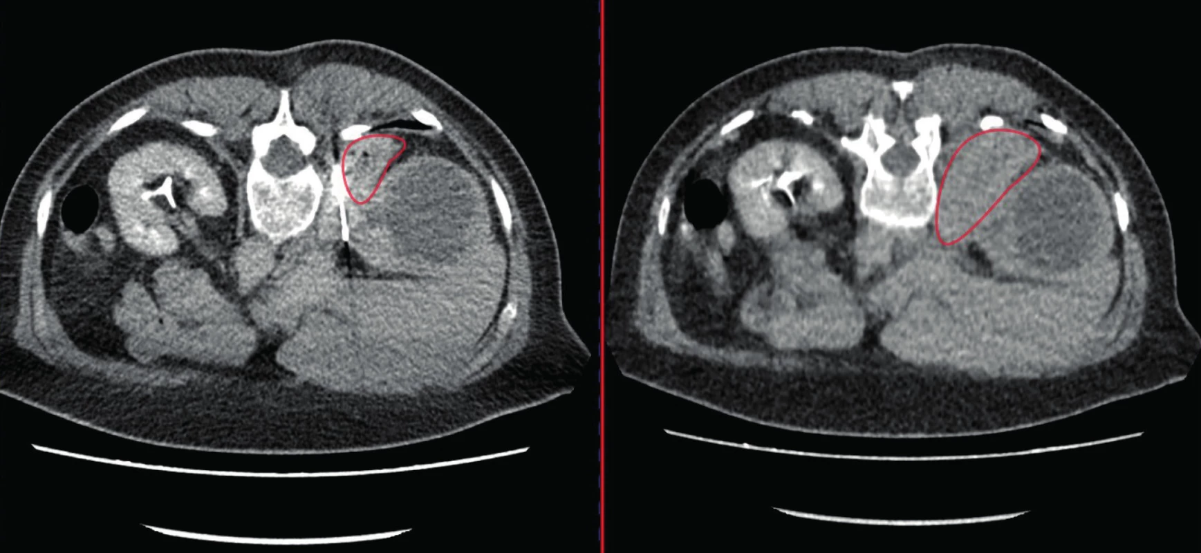 CT, transverzální řez; biopsie pravé ledviny komplikovaná hematomem; vlevo hematom v průběhu
biopsie, vpravo po dokončení biopsie<br>
Fig. 1. CT scan, transverse plane; the biopsy of the right kidney became complicated due to hematoma; in the
left picture – hematoma during the biopsy, in the right picture – hematoma after the biopsy