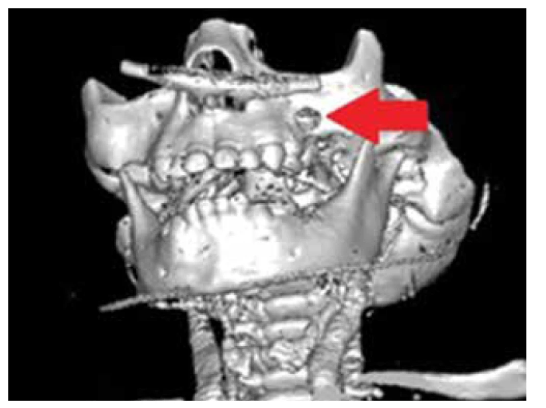 3D rekonštrukcia CT maxily s vyznačeným osteolytickým
defektom nad ľavým alveolárnym výbežkom (zdroj:
archív autorov).<br>
Fig. 4. 3D CT scan of maxilla with marked osteolytic defect
above the left alveolar ridge (source: authors’ archive).