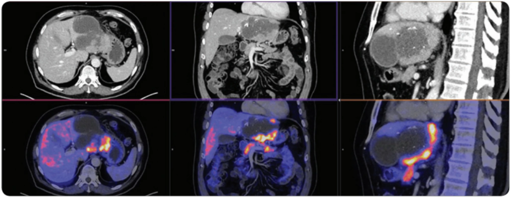 Vyšetření PET/CT s podáním 18F-fl uorodeoxyglukózy u dobře diferencovaného karcinomu, vyšetření PET/CT po chemoembolizaci ukazuje, že část hepatocelulárního karcinomu nekrotizovala, ale část nádorové tkáně po obvodu je viabilní.