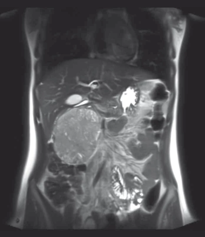 Obraz nitrobřišní expanze při vyšetření MRI (koronární řez).