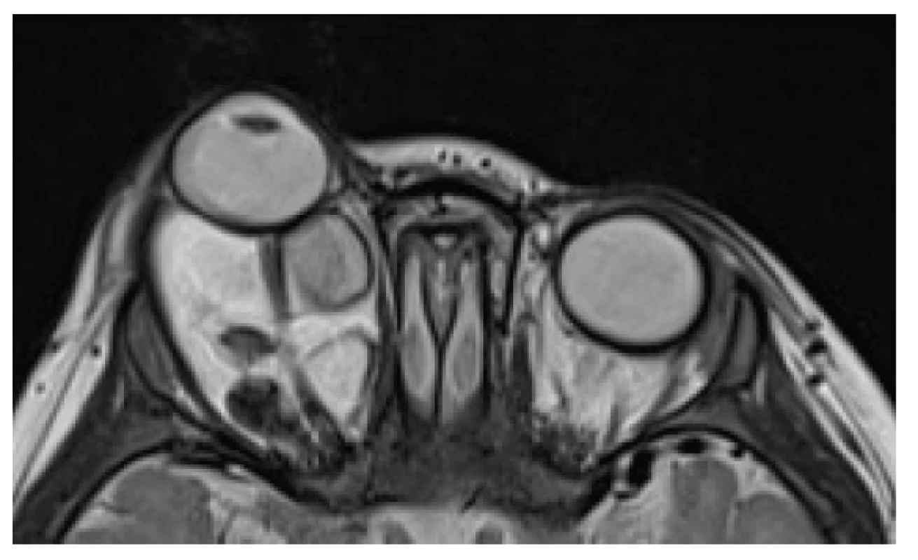 MRI examination at the age of 10 months with
evident proptosis of the right eyeball and stretching of the
optic nerve