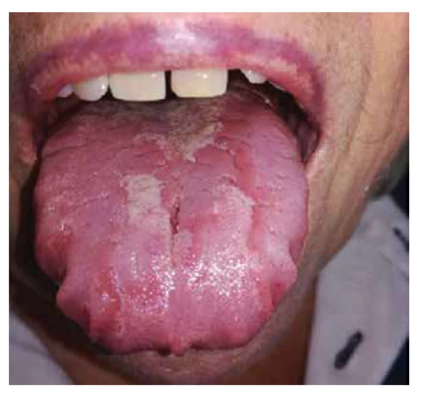 Pacientka s lingua geografica, kde dorsum linguae
tvoria atrofované papily. Známky regenerujúcich sa papíl
je vidieť v stredovej čiare. Po okrajoch jazyka sú otlaky od
zubov.