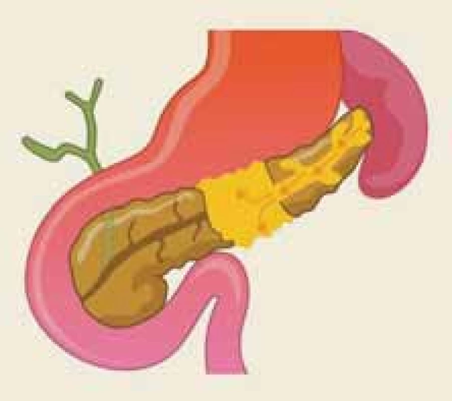 Anatomická situace při syndromu odpojeného pankreatického vývodu – ilustrace.<br>
Fig. 3. The anatomical situation of the
disconnected pancreatic duct syndrome – an illustration.