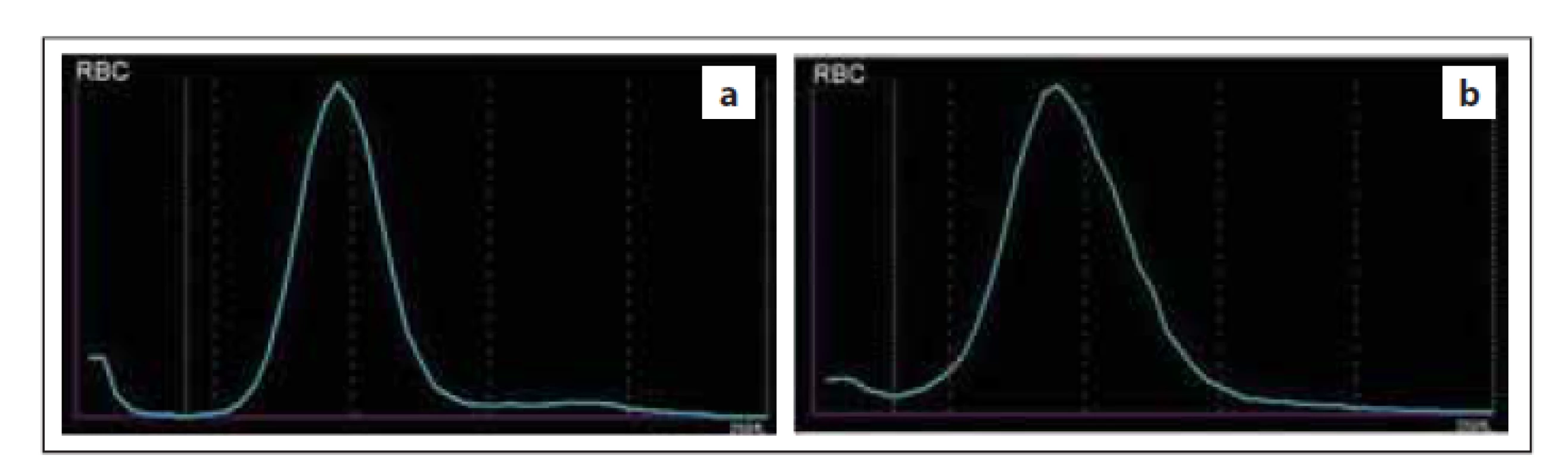 Normální průběh distribuční křivky RBC – (a) normální šíře distribuční
křivky (RDW), (b) vyšší šíře distribuční křivky (RDW) způsobená anizocytózou
erytrocytů (zdroj: laboratoř IV. IHK).<br>
RBC – erytrocyty, RDW – šíře distribuce erytrocytů
