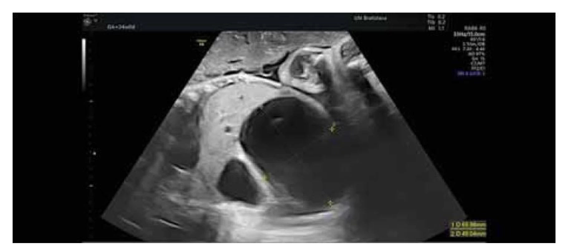 Plod v 34. týždni gestácie – axiálny ultrasonografický pohľad, progresia
anechogénnych cýst obličky veľkých rozmerov spôsobujúce už útlak bránice.<br>
Fig. 3. Fetus in the 34th week of gestation – axial ultrasonographic view, progression
of large anechoic kidney cysts already causing diaphragmatic pressure.