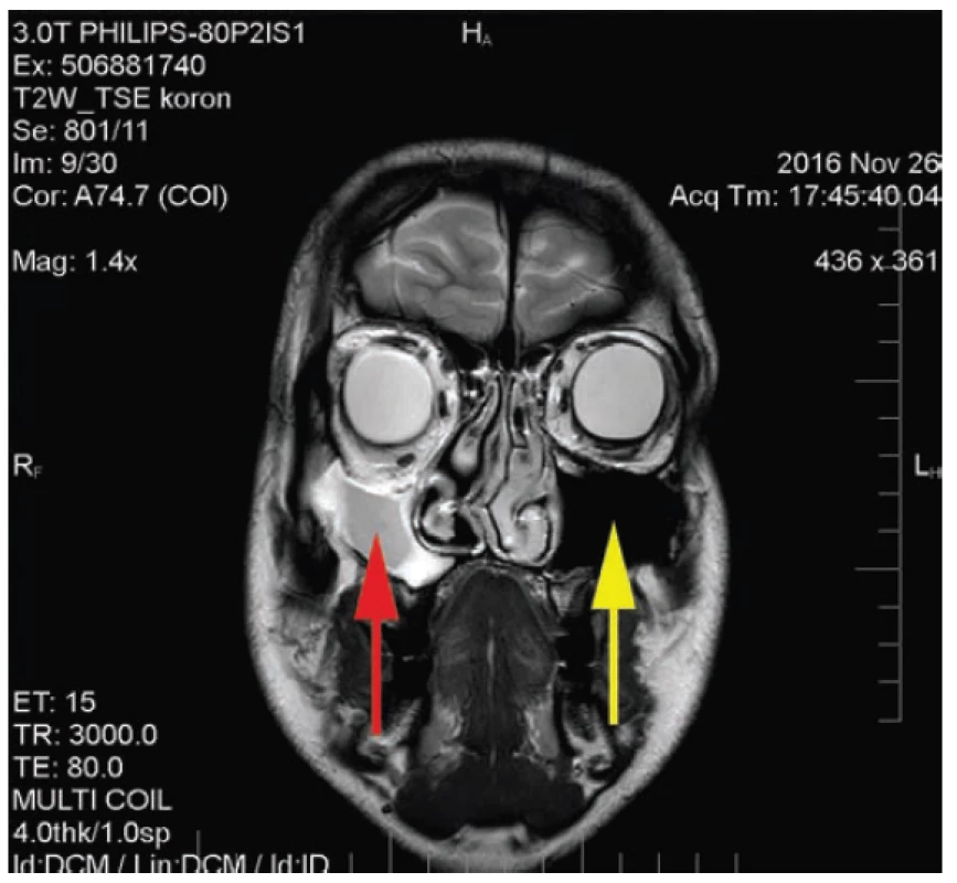 MR scan: reduction of the right maxillary sinus, left maxillary
sinus normal size and ventilation