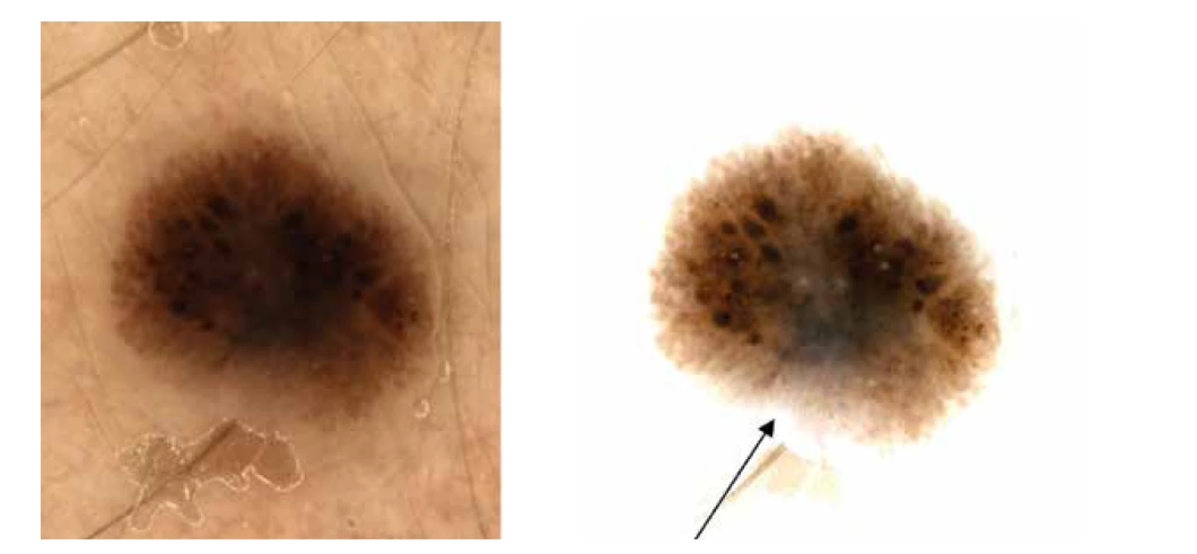 a,b. Dermatoskopicky naznačen obraz připomínající Reedův névus<br>
Na pravém snímku (b) také šedavé zastření v dolní střední části léze (šipka), jinak i naznačená dvouvrstevnatost.