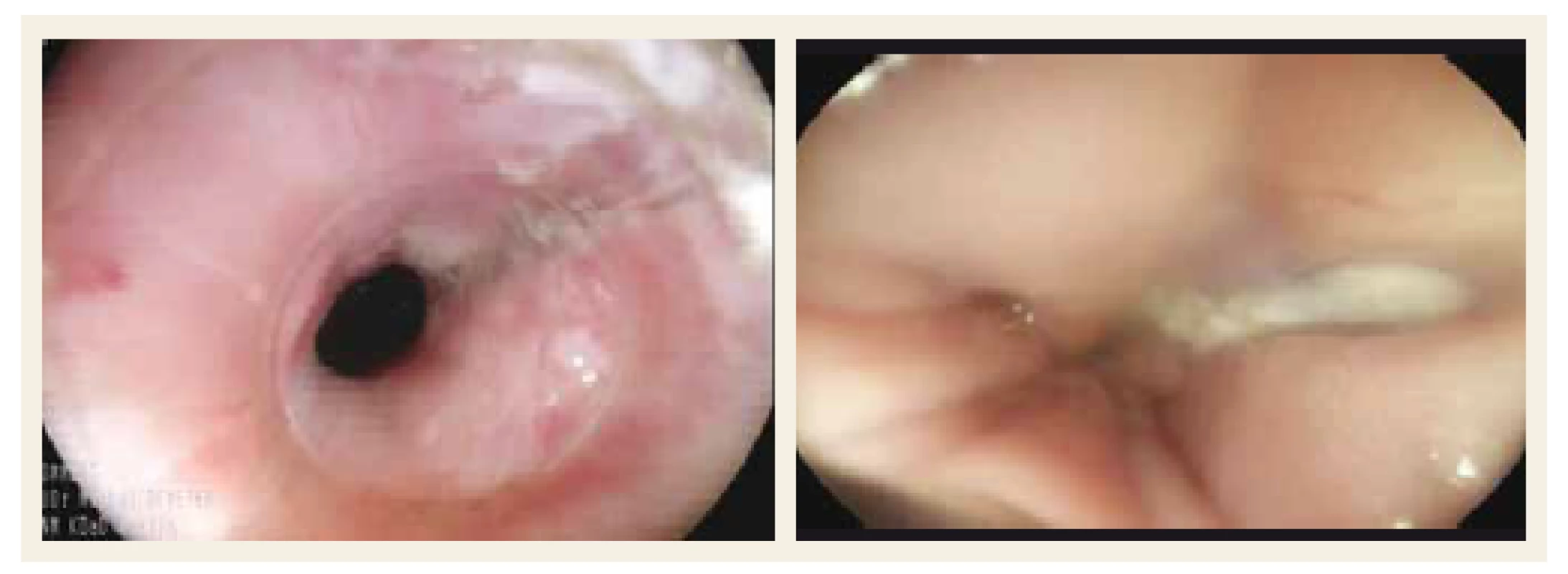Endoskopický obraz termického poškodenia pažeráka.<br>
Fig. 4. Endoscopic picture of thermal oesophageal damage.