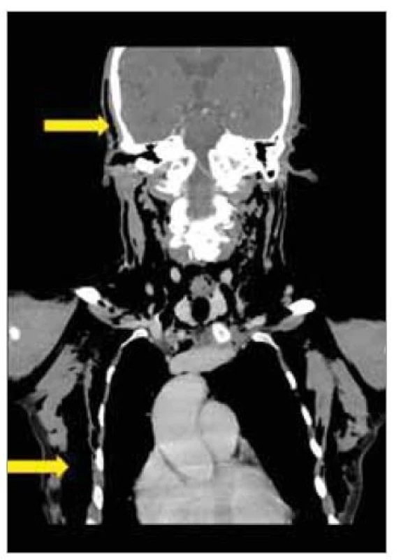 Kazuistika 3 – CT obličejového
skeletu, krku a hrudníku nativní.
Rozsáhlý podkožní emfyzém začínající
v temporálních oblastech hlavy
(šipka), jdoucí přes krk a následně obklopující
celý hrudník (šipka).<br>
Fig. 1. Case report 3 – CT of the facial
skeleton, neck and chest native. Extensive
subcutaneous emphysema beginning
in the temporal areas of the head,
going across the neck and subsequently
surrounding the entire chest.