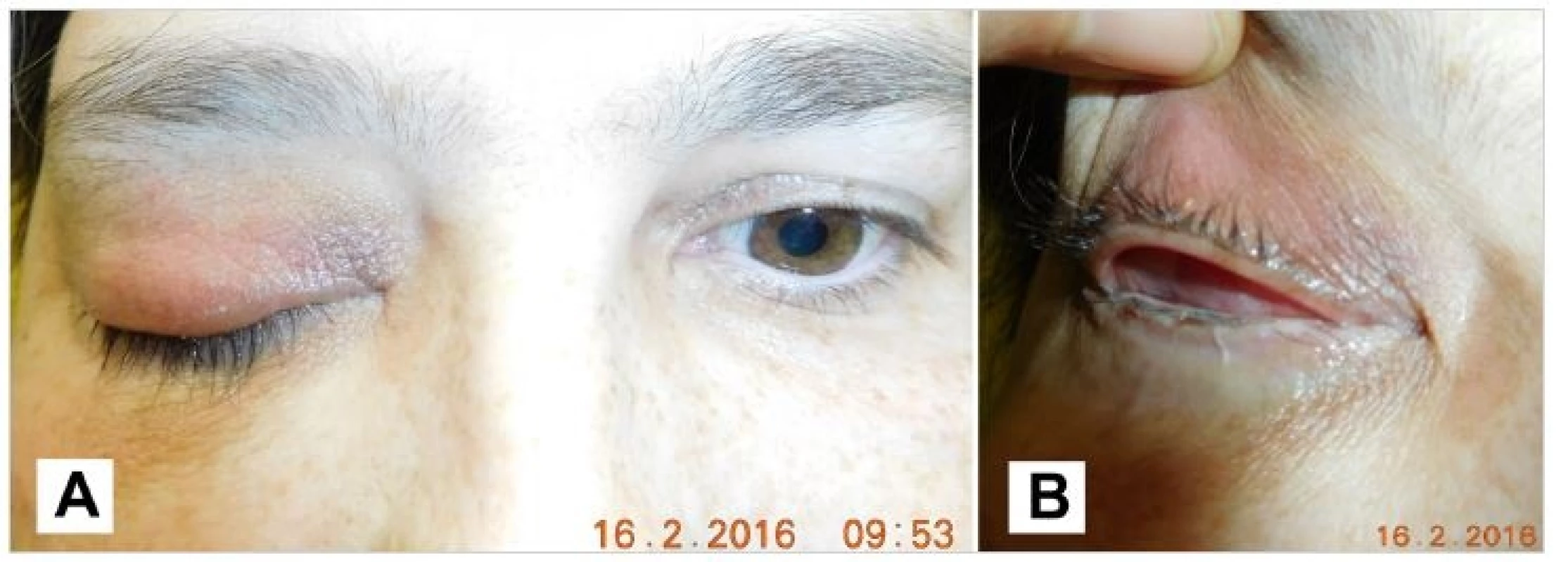 Patient after the surgery 2/2016, pseudoptosis (A), detail of the conjunctival sac (B)