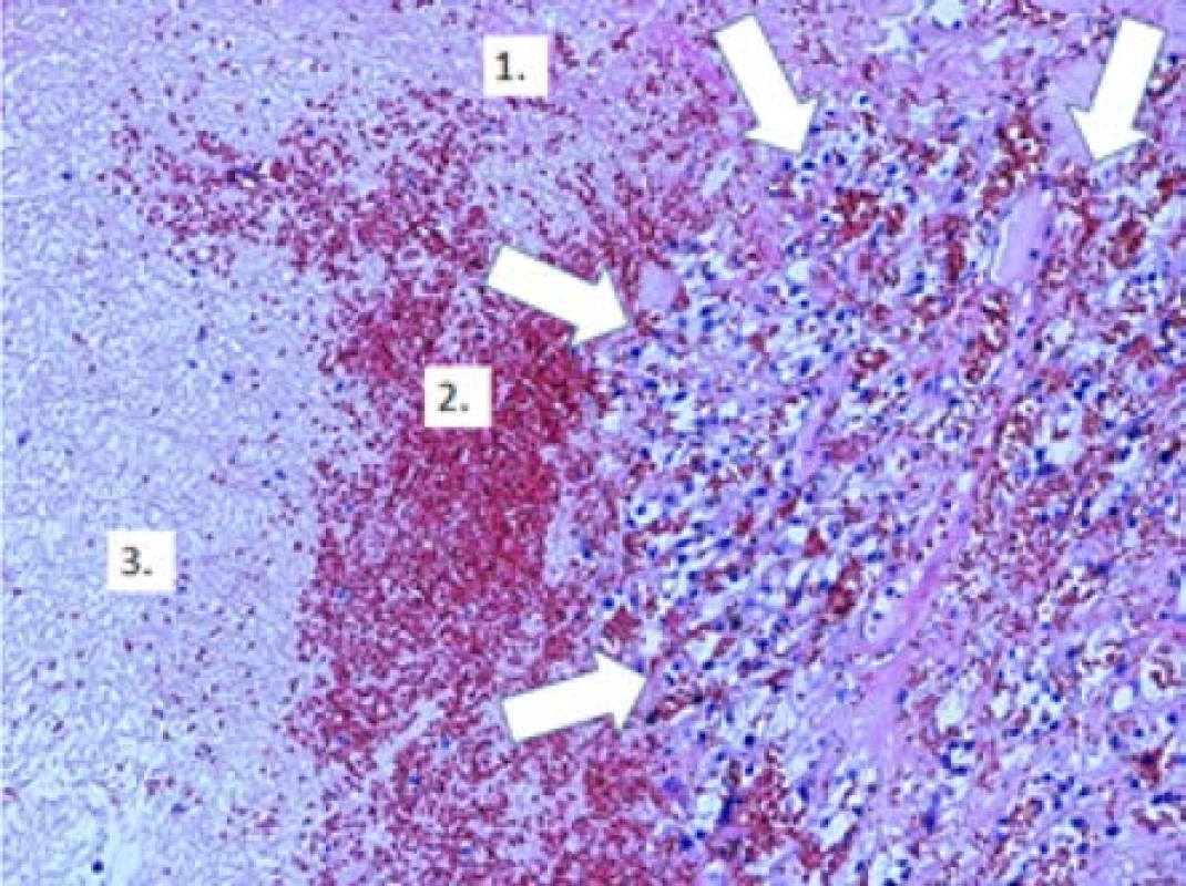 Zbytky světlobuněčného karcinomu (označeno
bílými šipkami), v okolí známky regrese nádoru s depozicí
fibrinu (1.), erytrocyty (2.) a ložisky nekrotické tkáně (3.);
původní zvětšení x100, hematoxylin-eosin<br>
Fig. 3. Residuals clear cell carcinoma (marked with
white arrows), around signs of tumor regression with
fibrin deposition (1.), erythrocytes (2.) and necrotic
tissue foci (3.). Original magnification x100, hematoxylin-
eosin