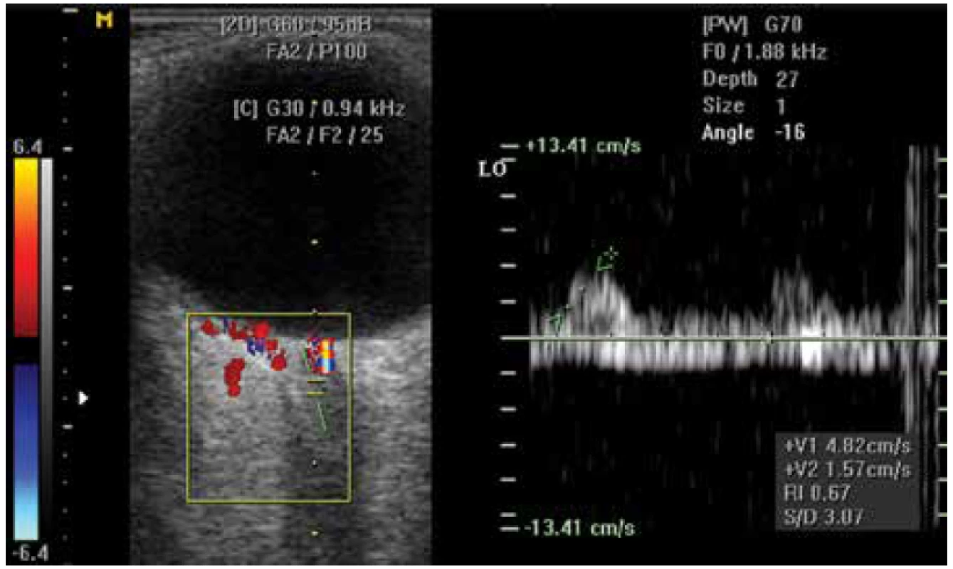 Farebná Doppler ultrasonografia - výrazne nízke prietokové parametre
v arteria centralis retinae