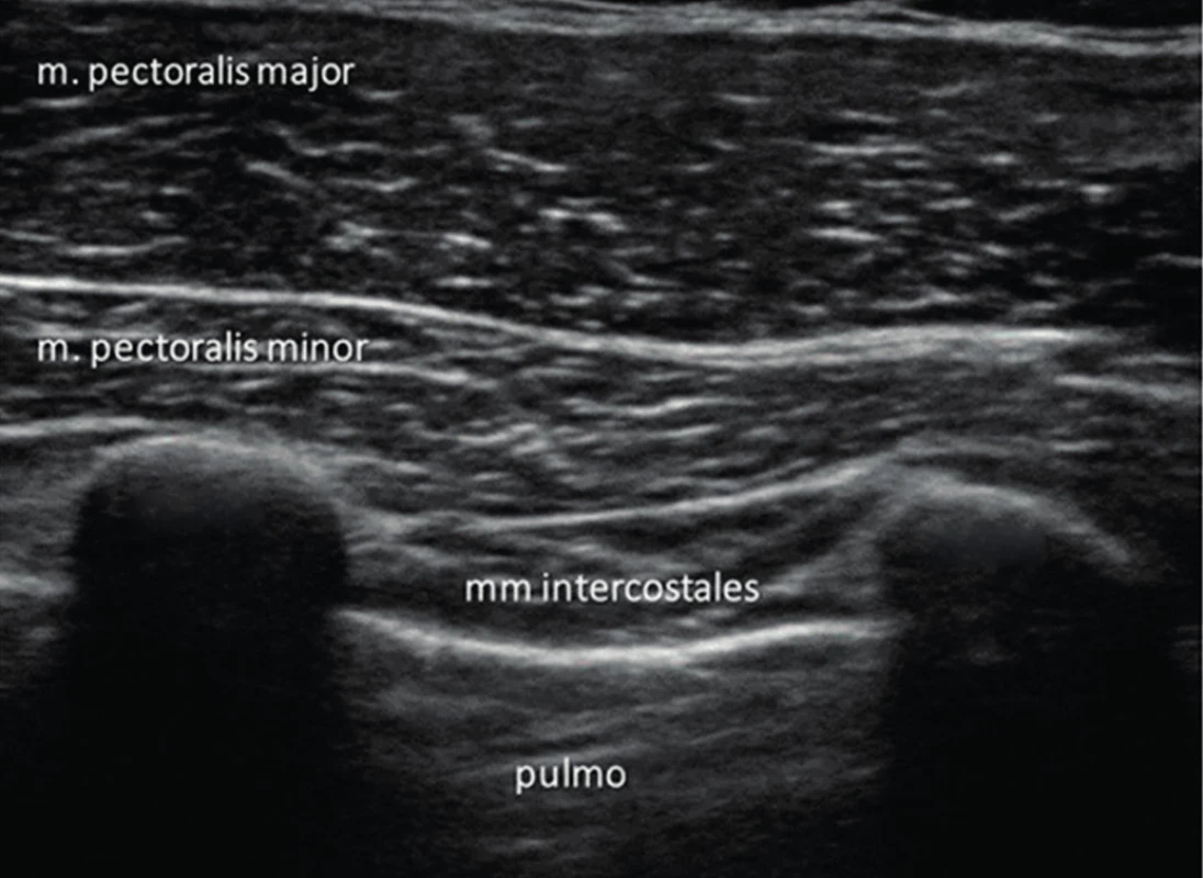 UZ obraz ve 3. mezižebří medioclaviculární čára. Jsou zřejmé tři
vrstvy svalů. Pectoralis major, pectoralis minor, interkostální svaly