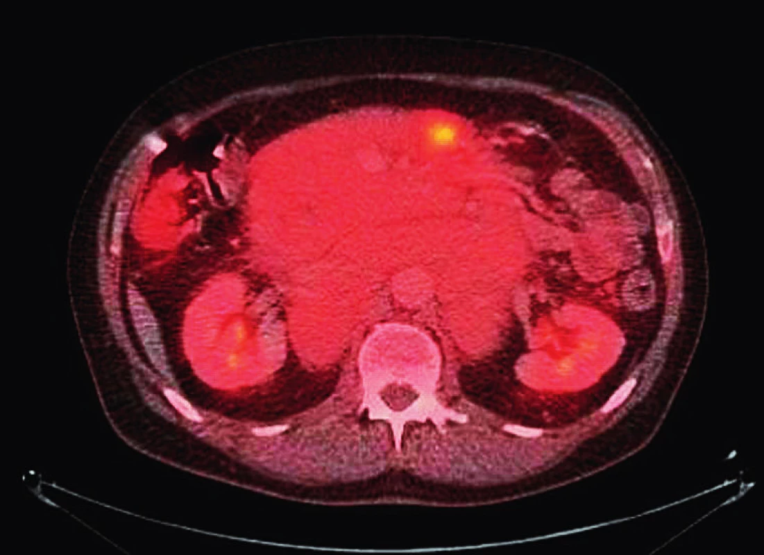 Axiální řez z fúze PET/CT ukazující masivní nitrobřišní lymfadenopatii s vysokou akumulací fluorodeoxyglukózy