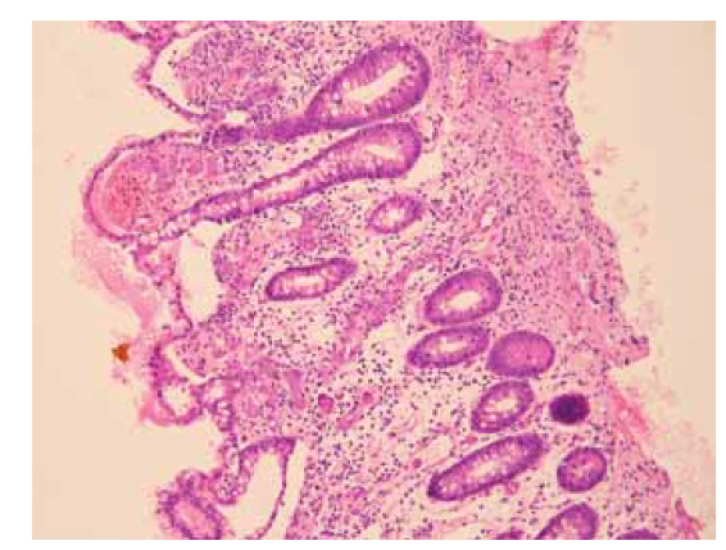 a) Sliznice tenkého střeva s přítomností početných
cytomegalovirových inkluzí v endoteliích a stromálních
buňkách lamina propria. V okolní sliznici je edém, drobné
hemoragie a smíšená zánětlivá celulizace kolísající intenzity
(hematoxylin a eozin, 200x).<br>
Fig. 1a) Small intestinal mucosa with the presence of numerous
cytomegalovirus inclusions in the endothelium and stromal
cells of lamina propria. Musocal oedema, minor hemorrhages
and mixed inflammatory cellulitis of variable intensity
in the surrounding mucosa are present (hematoxylin and eosin,
200x).