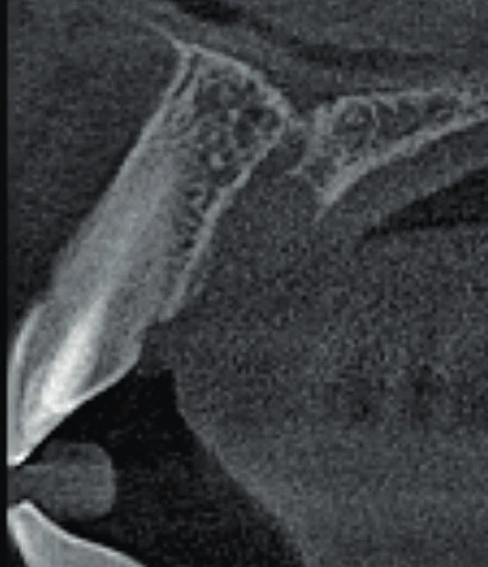 Axiální řez CBCT
snímku meziálně od zubu 11.
Je viditelné rozšíření nazopalatinálního
kanálu, které
nemá spojitost se zubem 11