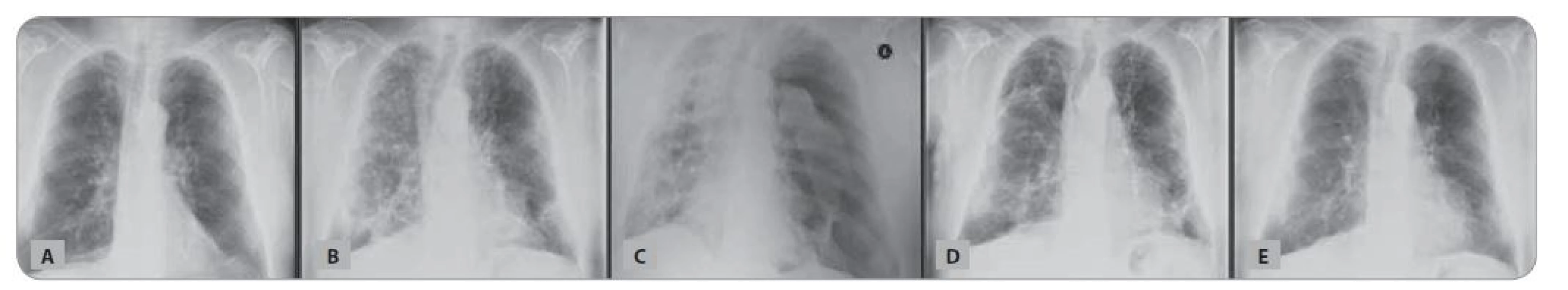 Skiagram hrudníku nemocného z Kazuistiky 3: A) před koronavirovou infekcí; B) bilaterální pneumonie COVID-19; C) subtotální
pneumotorax vlevo; D) plášťový pneumotorax vpravo; E) s odstupem 4 měsíců.