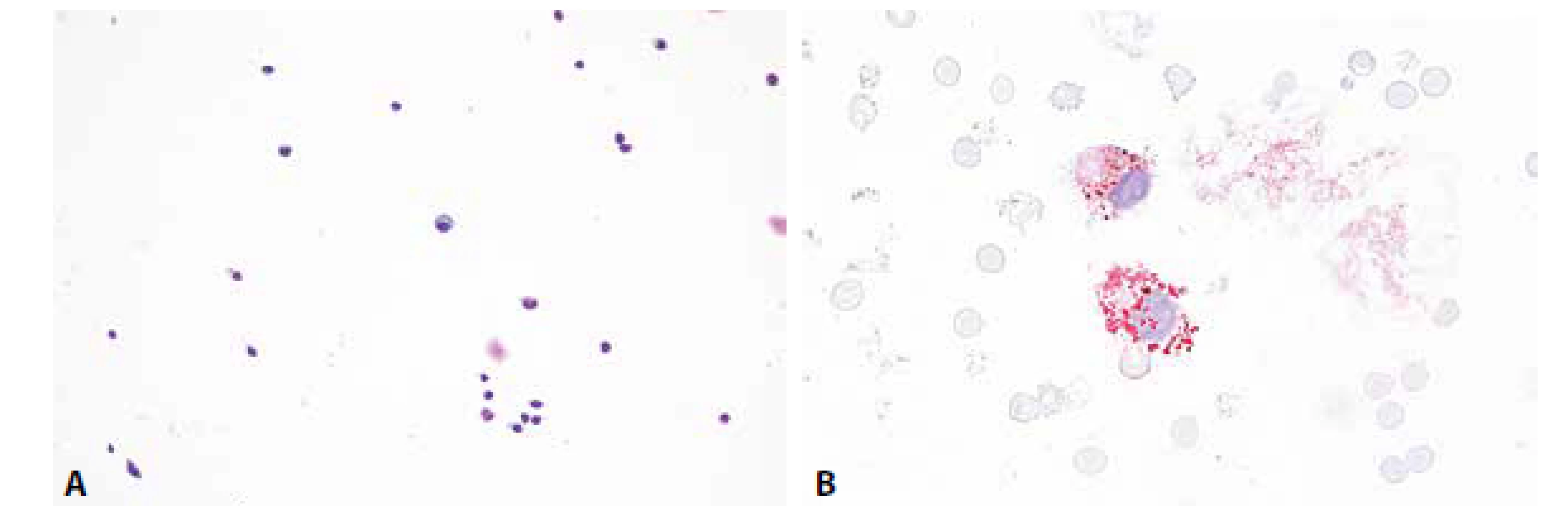Ilustrační případ 3. Roztroušená skleróza. (A) Mírná lymfocytární pleocytóza, v centru zralá plazmatická buňka. MGG, 200x. (B) Lipofagická
reakce je u RS většinou diskrétní, omezená na akutní fázi onemocnění. Olejová červeň, 400x.