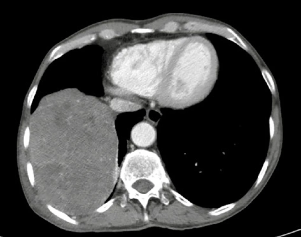 CT hrudníku s obrazem objemného tumoru pravého
hemithoraxu<br>
Fig. 2: CT-scan of the chest showing a voluminous tumor
mass in the right hemithorax