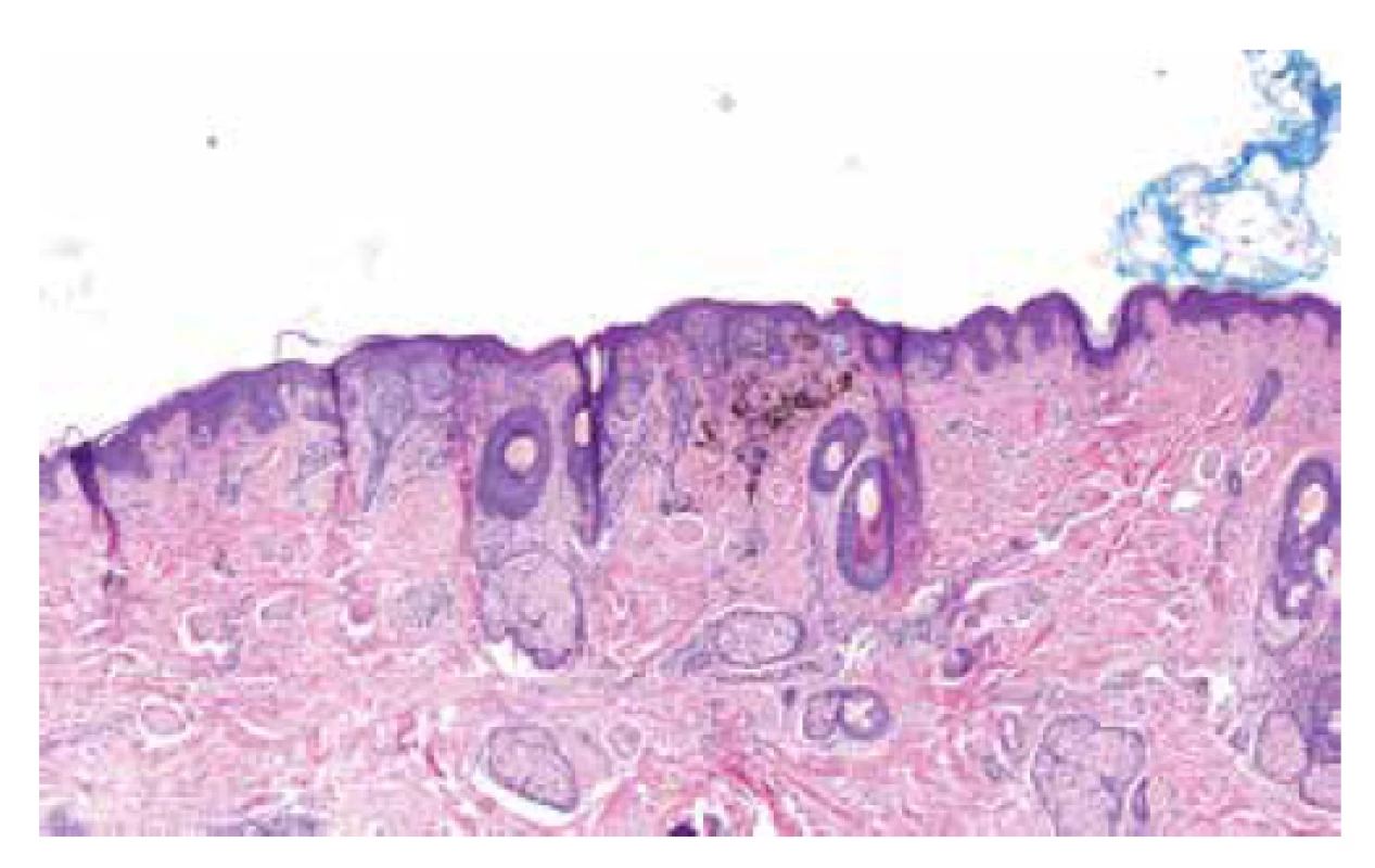 Histopatologický obraz (HE, 40x)