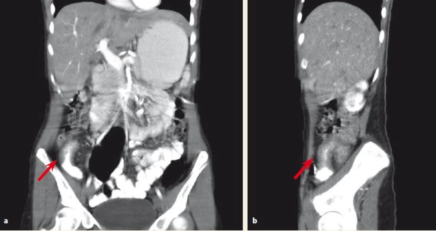 a,b. Abdominal CT scan. Affected terminal ileum marked with an arrow.<br>
Obr. 1a,b. CT vyšetření břicha. Postižení terminálního ilea označeno šipkou.