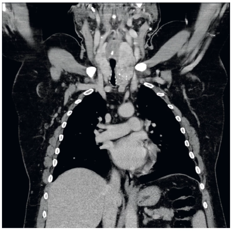CT snímek před zavedením stentu (koronární) - objemná
struma utlačující tracheu částečně zasahující do mediastina.