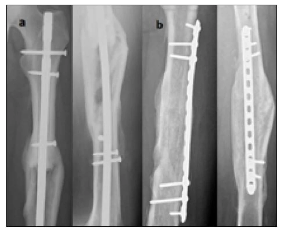 Nedostatečné hojení tříštivé zlomeniny diafýzy po OS IM hřebem
– řešeno konverzí na dlahovou osteosyntézu se spongioplastikou,
a) přehojení pouze po obvodu kosti s centrálním defektem po antegrádně
zavedeném hřebu UFN, b) zhojeno po konverzi na dlahovou
osteosyntézu a výplní defektu spongiózní kostí – 6 měsíců po revizní
a 18 měsíců po primární operaci