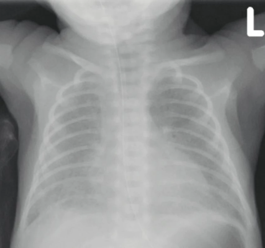 Na skiagramu hrudníku u dívky narozené ve 27. gestačním týdnu s mírnou formou BPD je patrná povšechně snížená vzdušnost obou plic odpovídající nálezu
„new“ BPD (archiv Radiodiagnostické kliniky
1. LF UK a VFN).<br>
Fig. 3. The chest X-ray of a girl born in the 27th gestational
week with a mild form of BPD shows a generally
reduced airiness of both lungs corresponding to the
finding of „new“ BPD (archive of the Department of
Radiology, First Faculty of Medicine, Charles University
and General University Hospital in Prague).